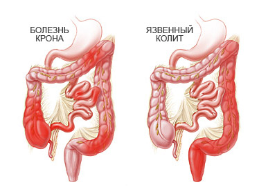 Школа по изучению воспалительных заболеваний кишечника