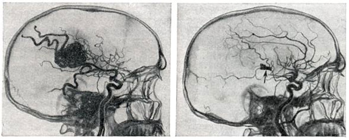 эндоваскулярное лечение артериовенозных фистул головы