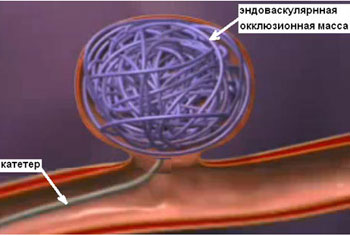эндоваскулярное лечение артериовенозных фистул головы